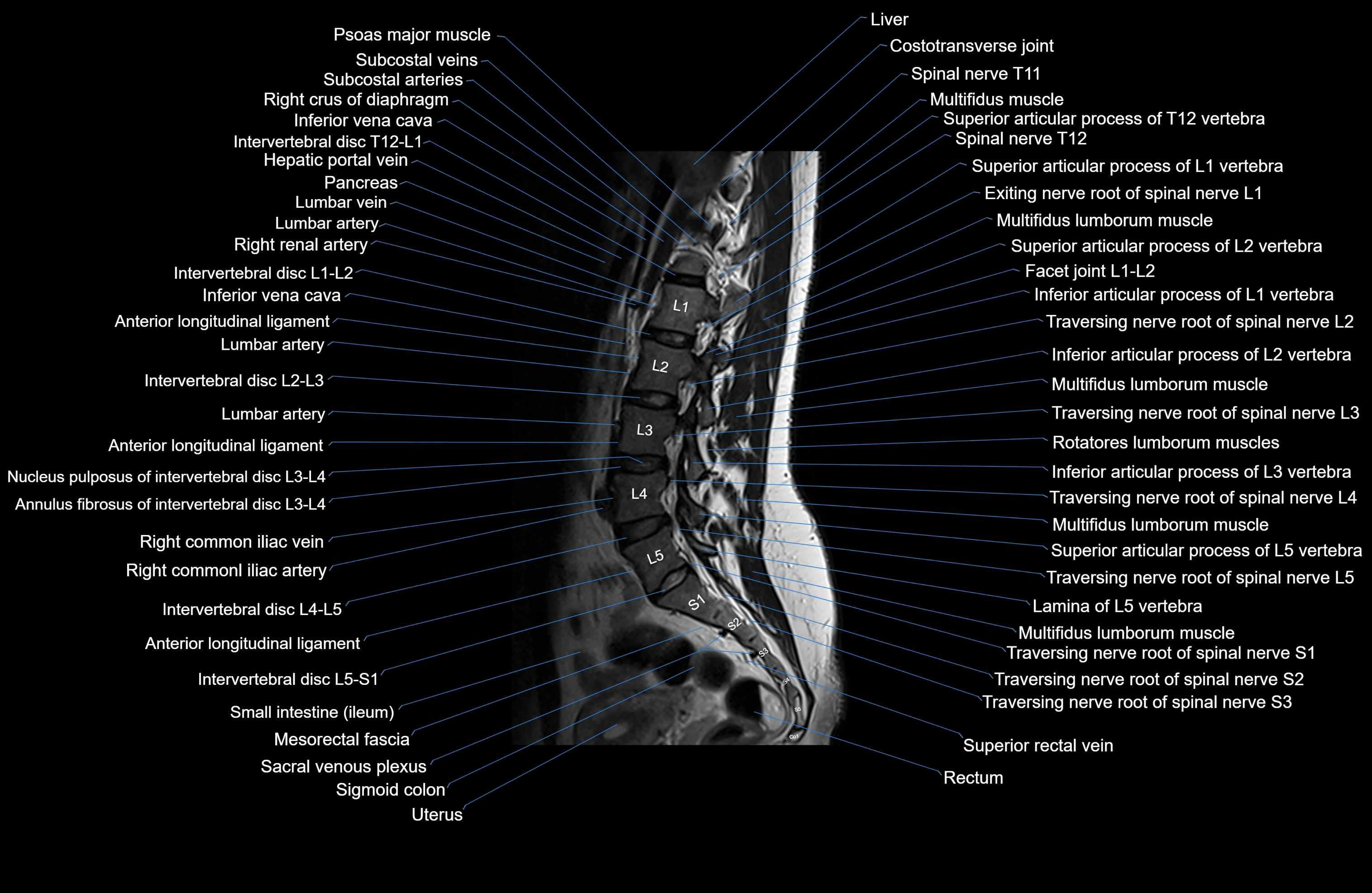 MRI lumbar spine sagittal cross sectional anatomy 3T radiology  image-img-00001-00009.webp